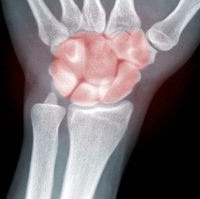 Impact Starts in the Lab: Using Preclinical Models to Combat Autoimmune & Autoinflammatory Arthritis